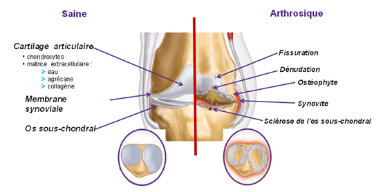 Schema-articulation-saine-vs-arthrosique.PNG Schema-articulation-saine-vs-arthrosique.PNG