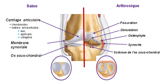 Arthrose : maladie chronique et affection dégénérative qui touche le  cartilage