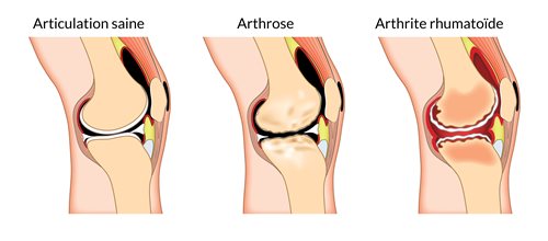 Articulation-saine,-arthrose,-arthrite.jpg